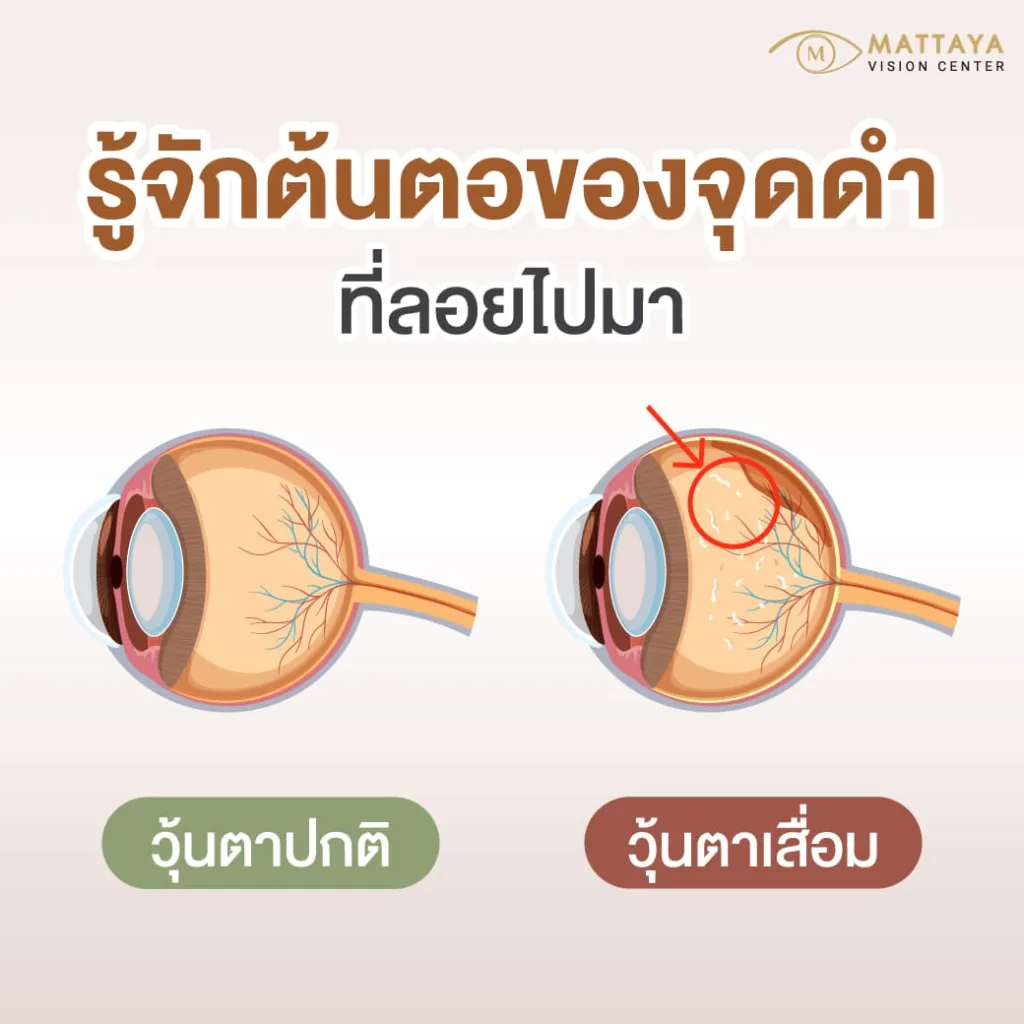เจาะลึกกลไกและกลุ่มเสี่ยง ทำไมฉันถึงเป็นวุ้นในตาเสื่อม?